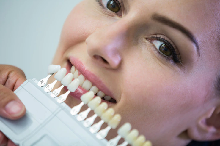 Veneers