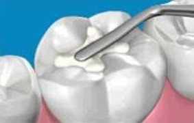 Fillings