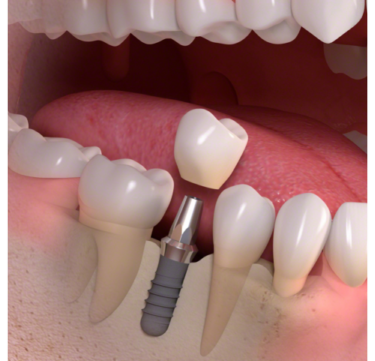 Dental Implants