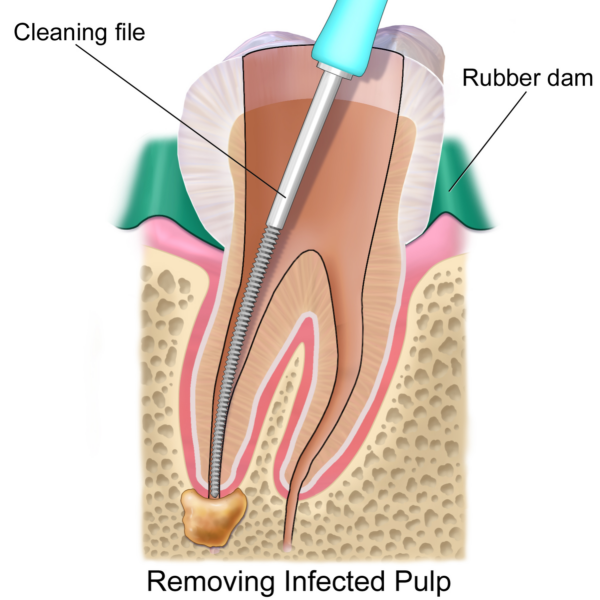 Root Canal Therapy